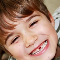 Kinder legen es manchmal ganz schön drauf an – auch in der Wackelzahnpubertät (Symbolbild). Kind zeigt seine Zahnlücke