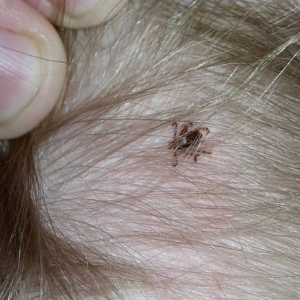 Zecke auf dem Kopf eines Kindes Zecke auf dem Kopf eines Kindes