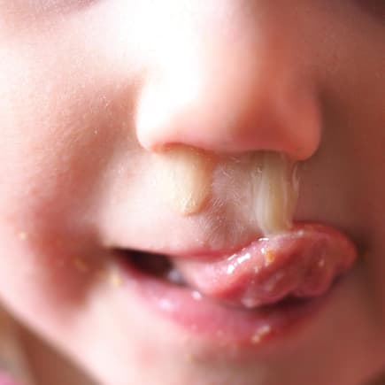 Kind mit dickem Schnodder Kind mit dickem Schnodder