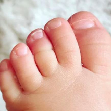 Beim Tourniquet-Syndrom wickelt sich ein Haar um den Zeh und kann so die Blutzufuhr abschnüren.