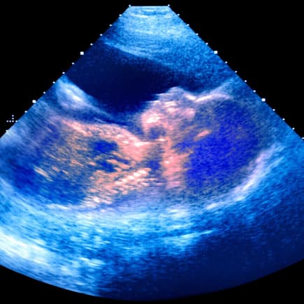Gender Disappointment bezeichnet die Enttäuschung, die manche Eltern empfinden, wenn das Geschlecht ihres Kindes nicht dem gewünschten entspricht. Ein Ultraschallbild, auf dem die Umrisse eines Babys zu erkennen sind