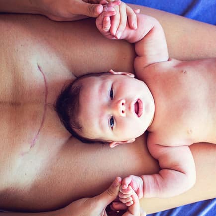 Viele Frauen sind sich unsicher, ob nach einem Kaiserschnitt eine natürliche Geburt noch möglich ist. Baby liegt auf Mutter mit Kaiserschnittnarbe.