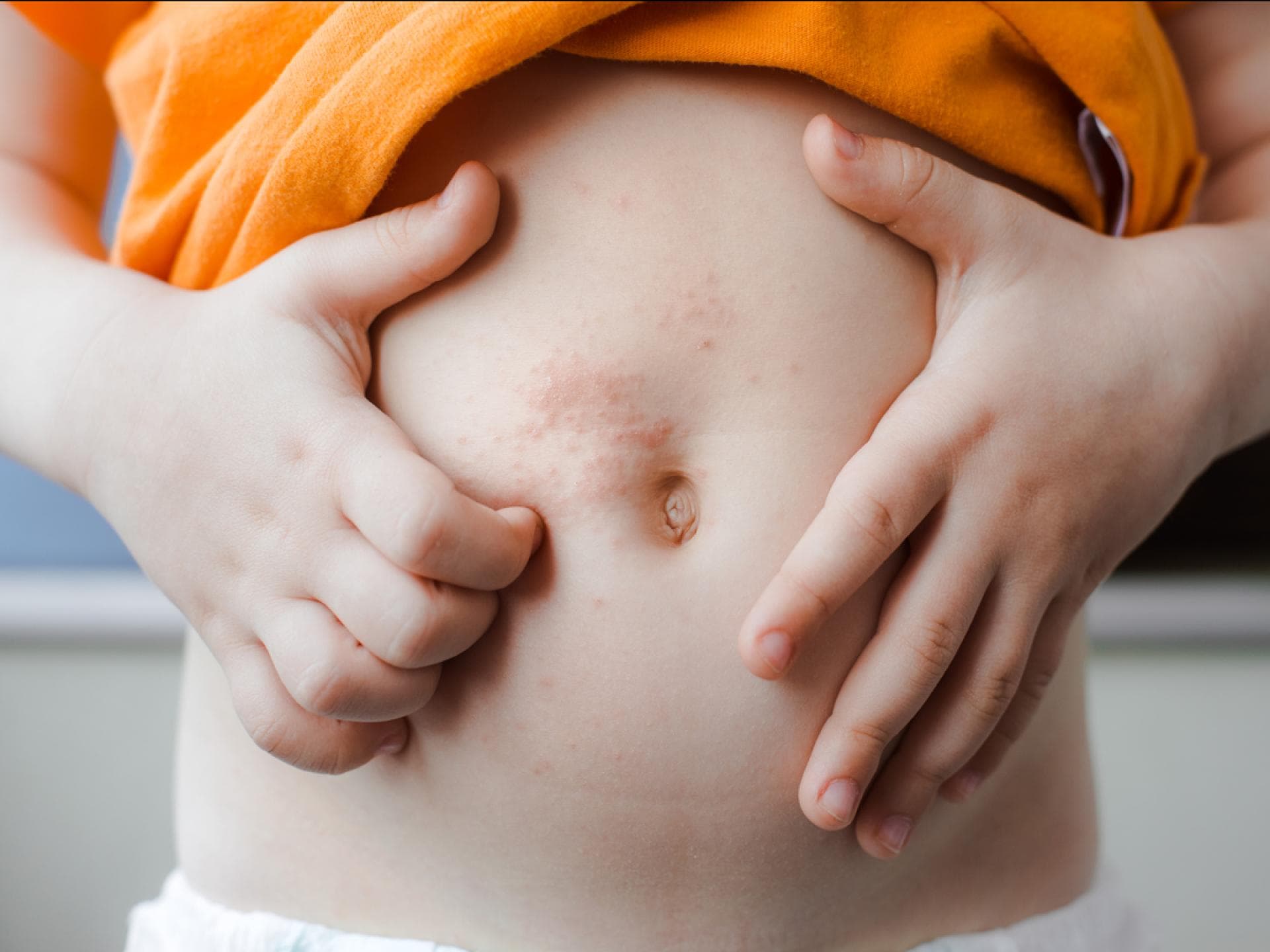 Eine Hirnhautentzündung könnt ihr durch einen Selbsttest mit einem Glas ausschließen. Eine Junge hat einen Hauttausschlag am Bauch.