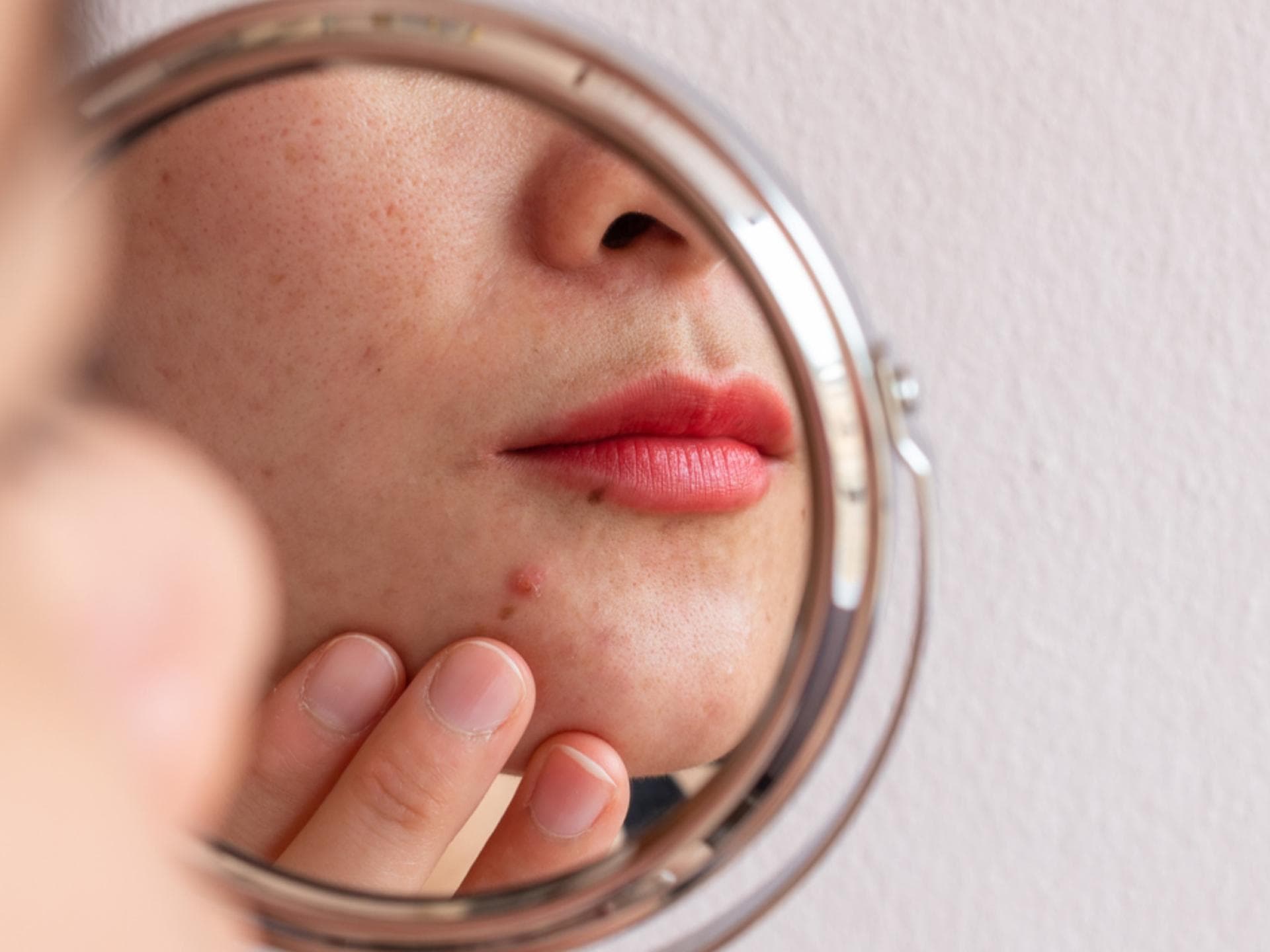 Pickel in der Schwangerschaft werden meist durch den veränderten Hormonhaushalt verursacht.